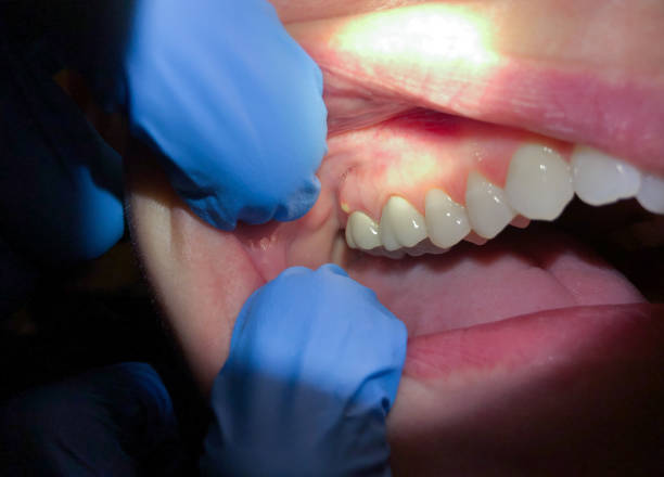 Best Urgent Care for Lost Fillings or Crowns in Millers Falls, MA